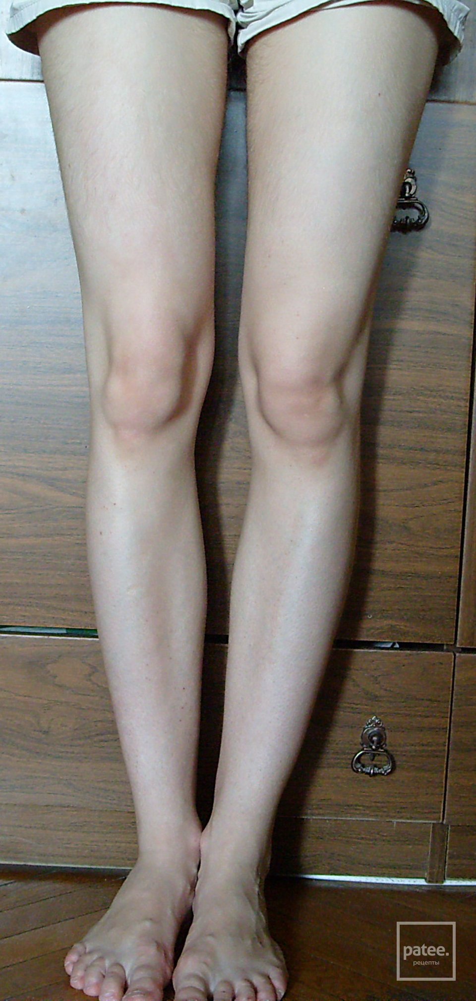 Круглые колени